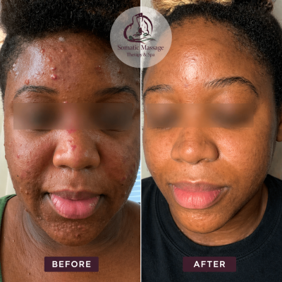 Clear and restore your skin with targeted acne treatments designed to reduce breakouts, calm inflammation, and improve skin texture. Our customized approach helps you achieve smoother, healthier, and more confident-looking skin.